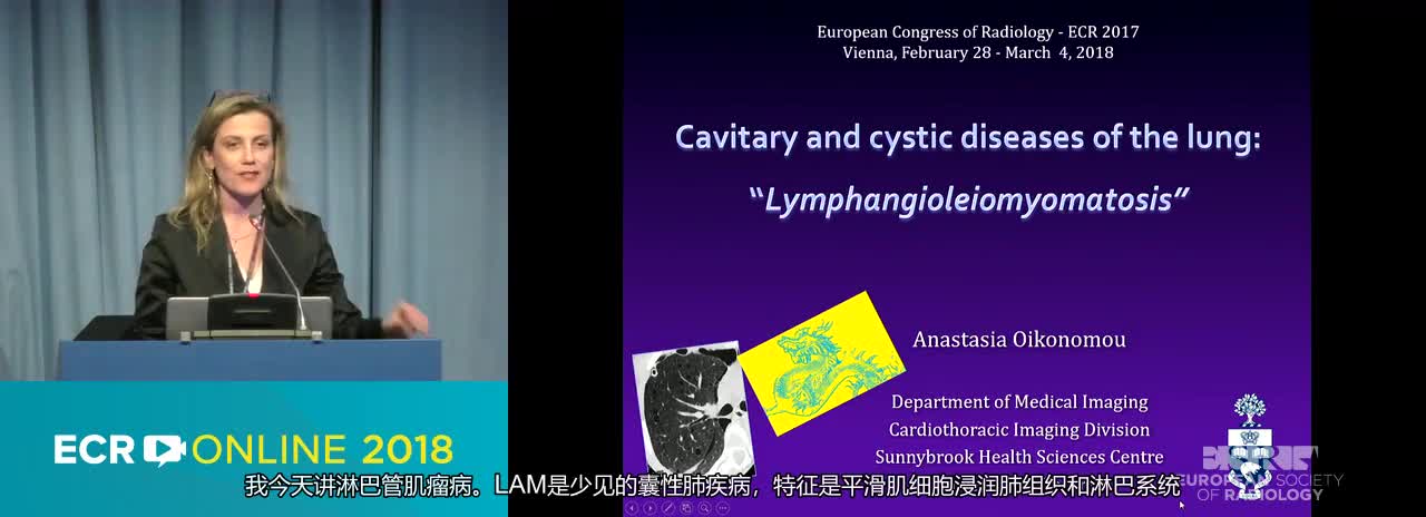 C. Lymphangioleiomyomatosis